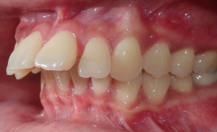 overbite-patient-1-before