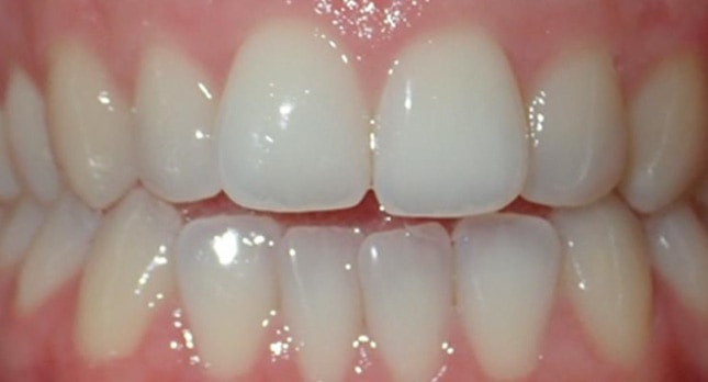 Openbite-Before-Patient-3-teeth-3
