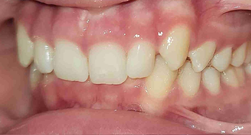 deep-bite-before-patient-2-1