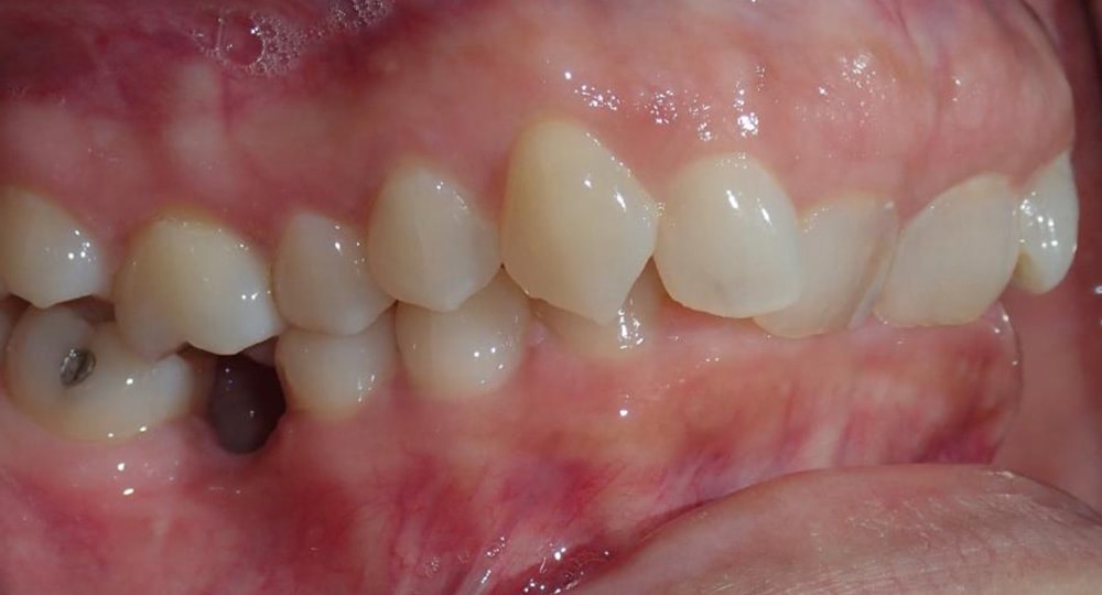 deep-bite-before-patient-3-1