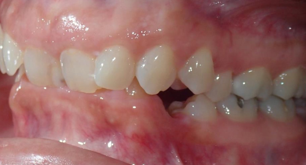 deep-bite-before-patient-3-3