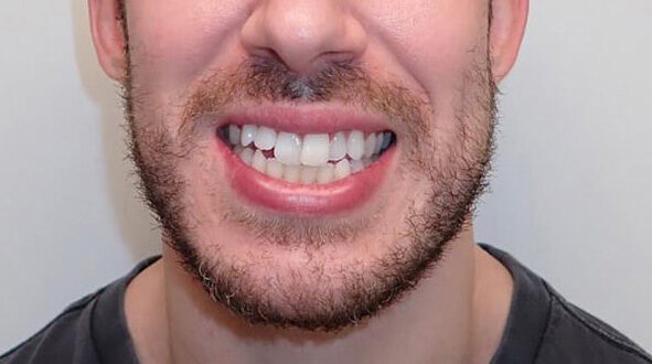 Crossbite-Before-Patient-1