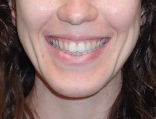 Openbite-Before-Patient-3