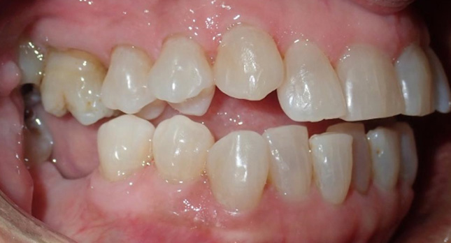 Openbite-Before-Patient-4-1