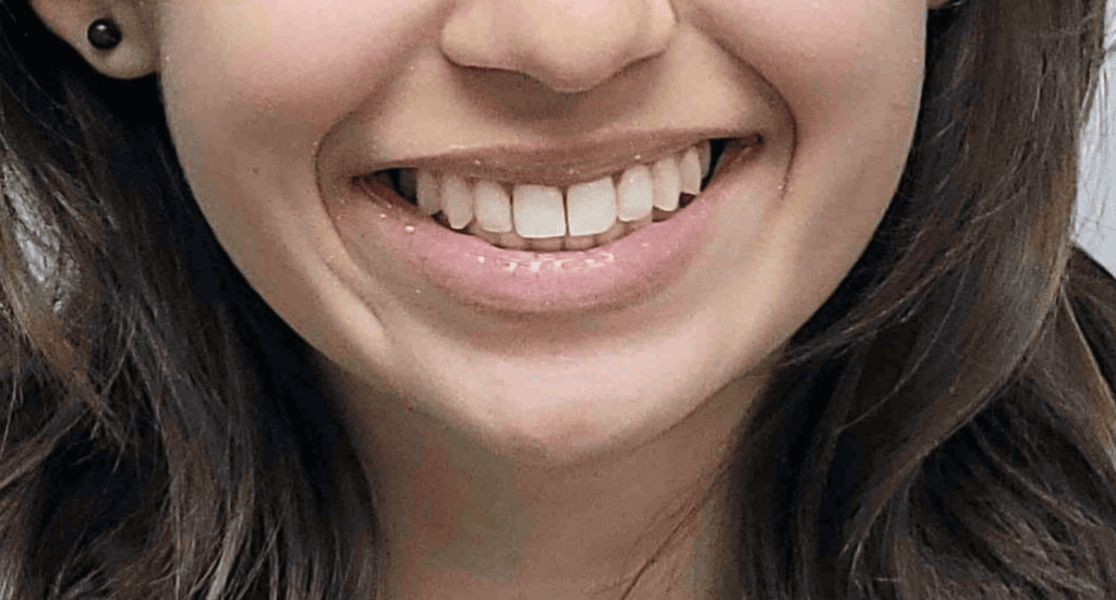 after photo of 1st patient who had crooked teeth