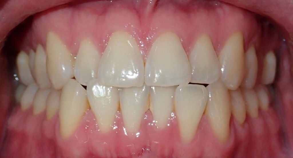 crossbite-Patient-2-Before-2