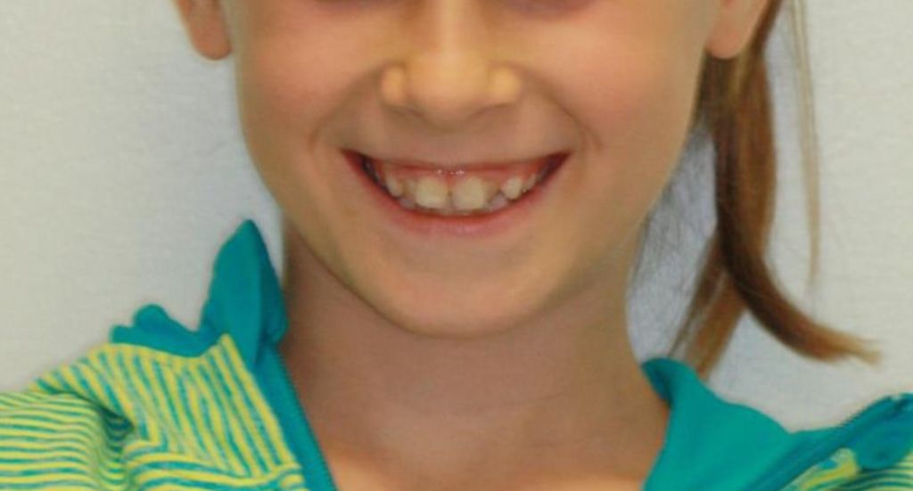 crossbite-Patient-3-Before-1