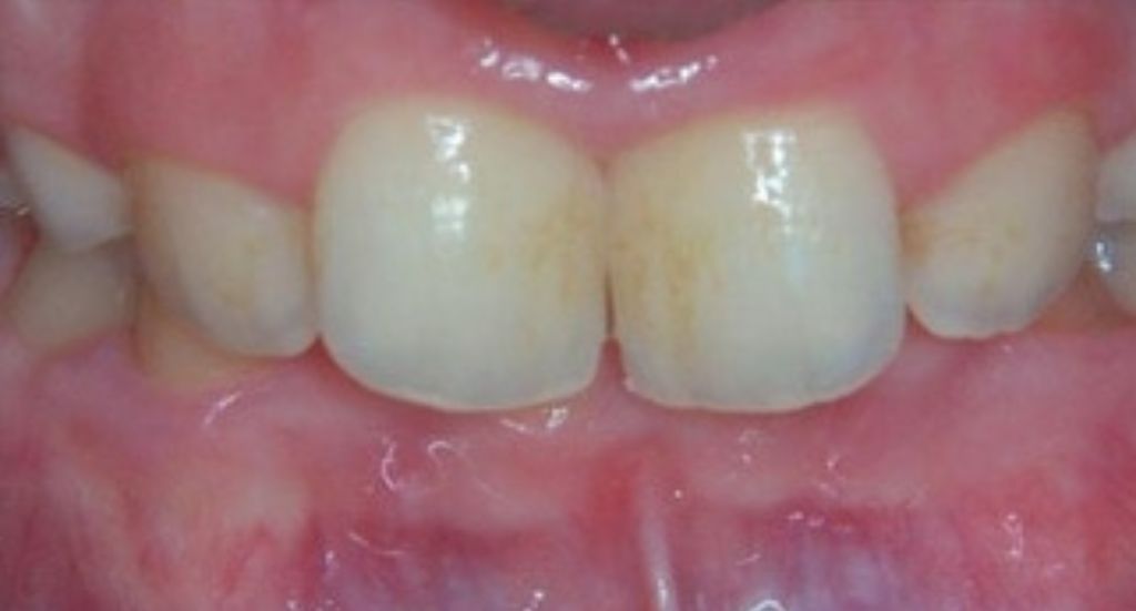 overbite-Patient-2-before2