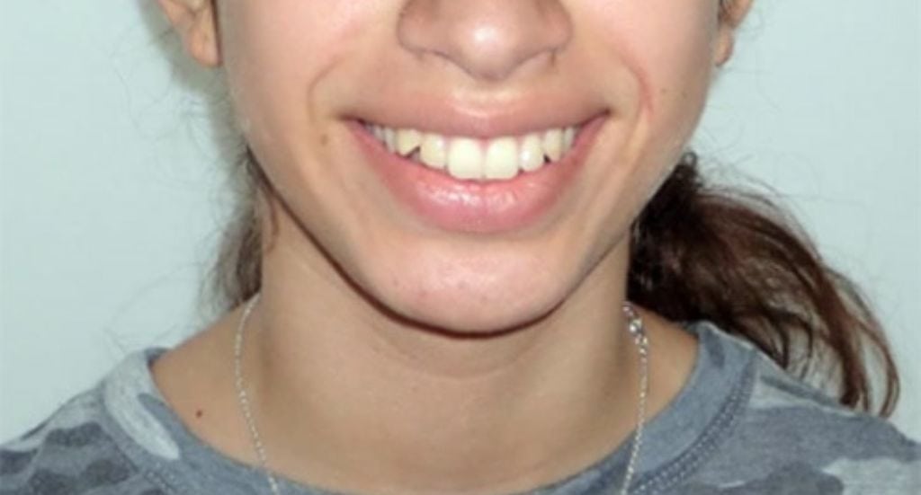 overbite-Patient-3-Before1