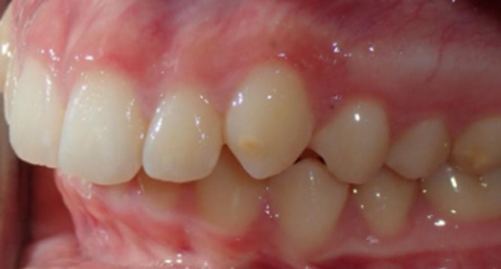 overbite-Patient-3-Before2