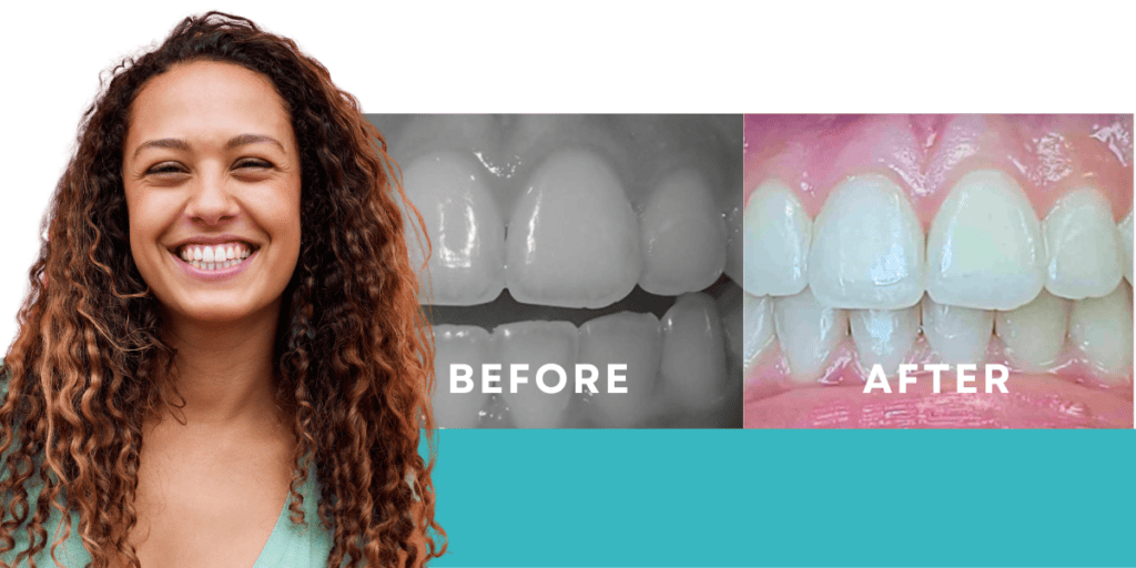 Openbite Before & After