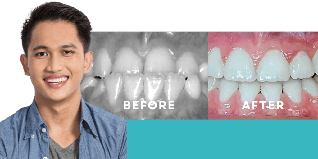 Underbite (aka Anterior Crossbite) Before & After