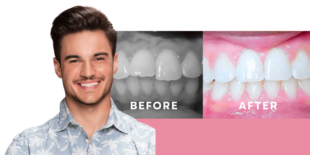 Braces before & after