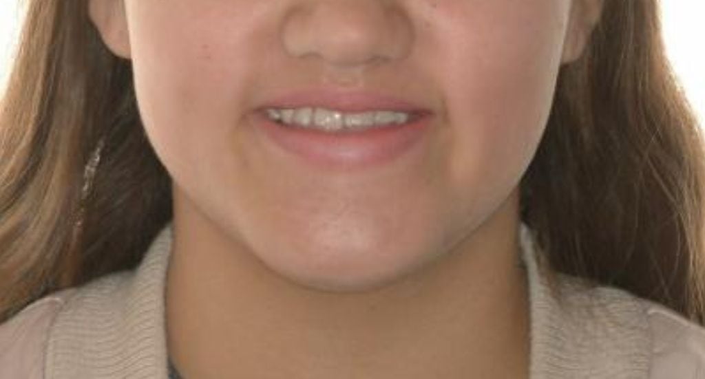 Braces-Patient-1-Before-1