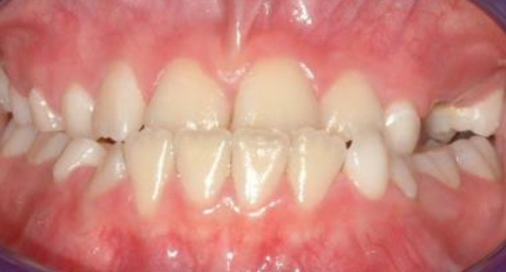 Braces-Patient-1-Before-2