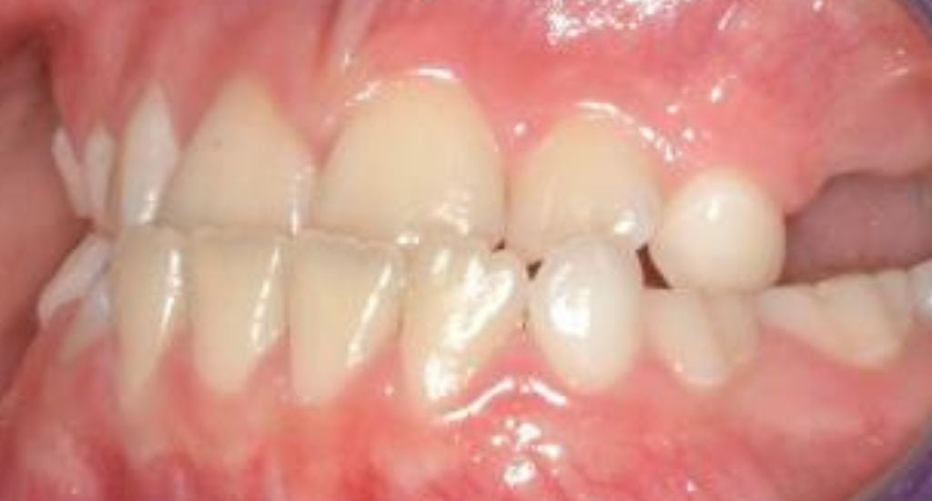 Braces-Patient-1-Before-3