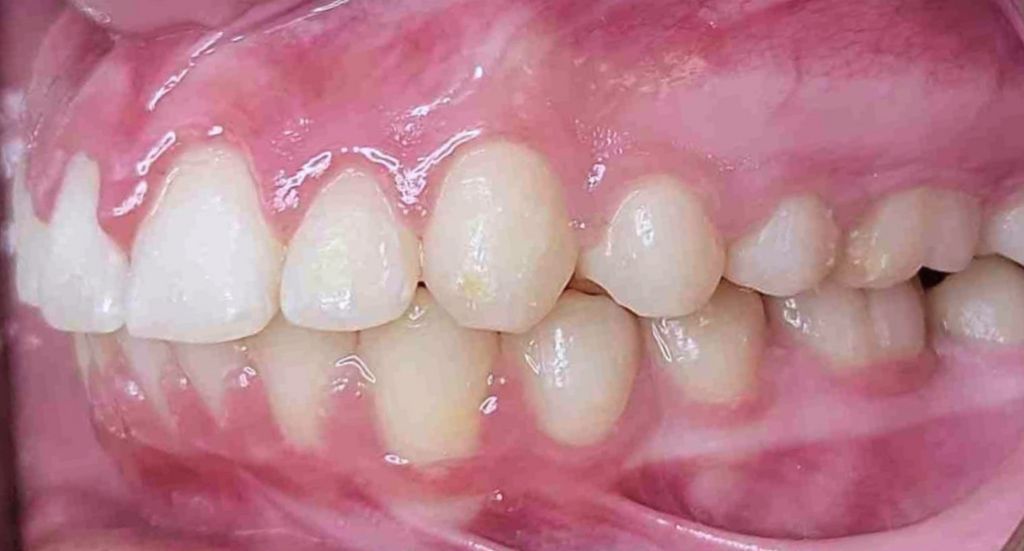 Braces-Patient-2-After-2