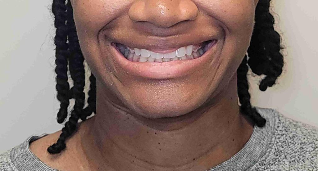 Braces-Patient-3-After-1