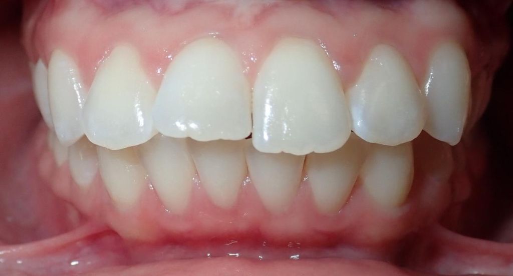 Braces-Patient-3-Before-2