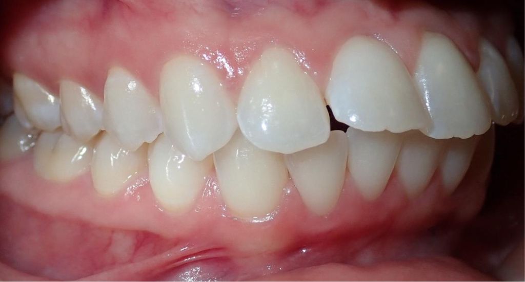 Braces-Patient-3-Before-3