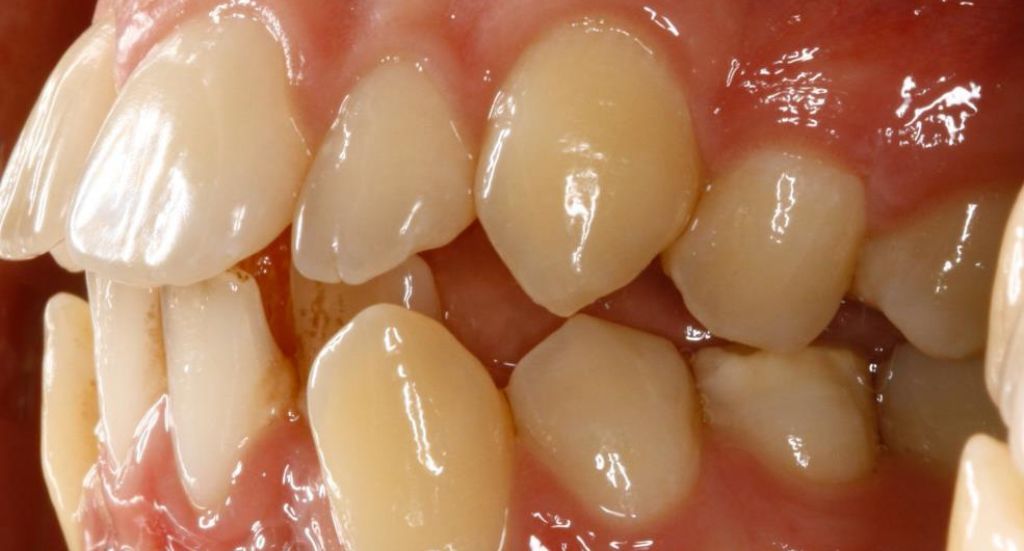 Jaw-Patient-3-Before-1