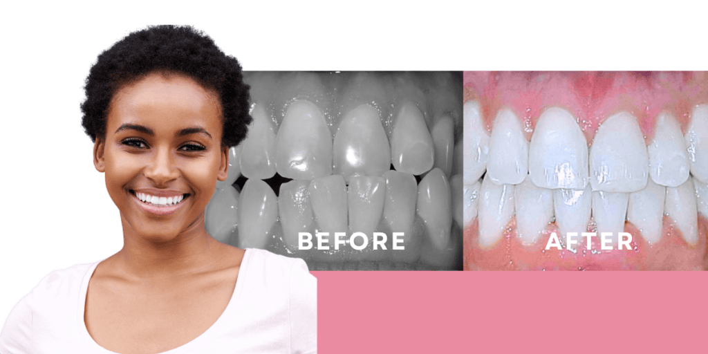 Jaw Surgery Before & After