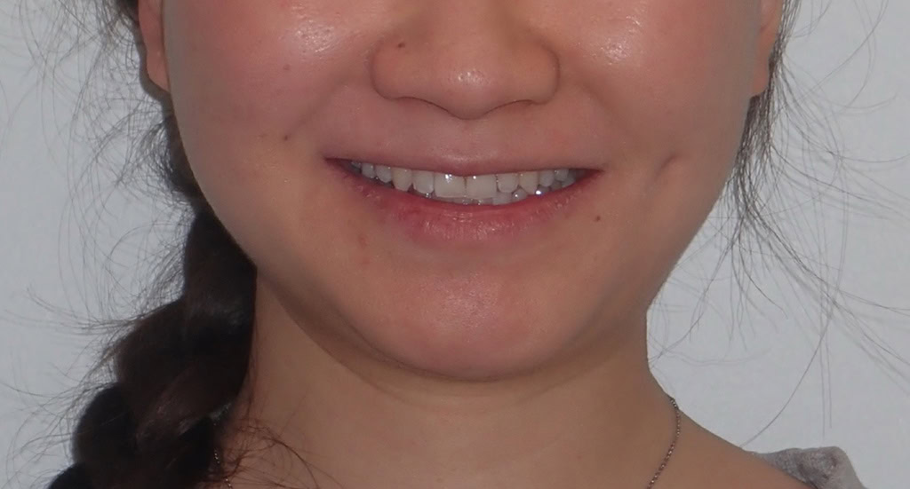 Patient 9 After Protrusion correction