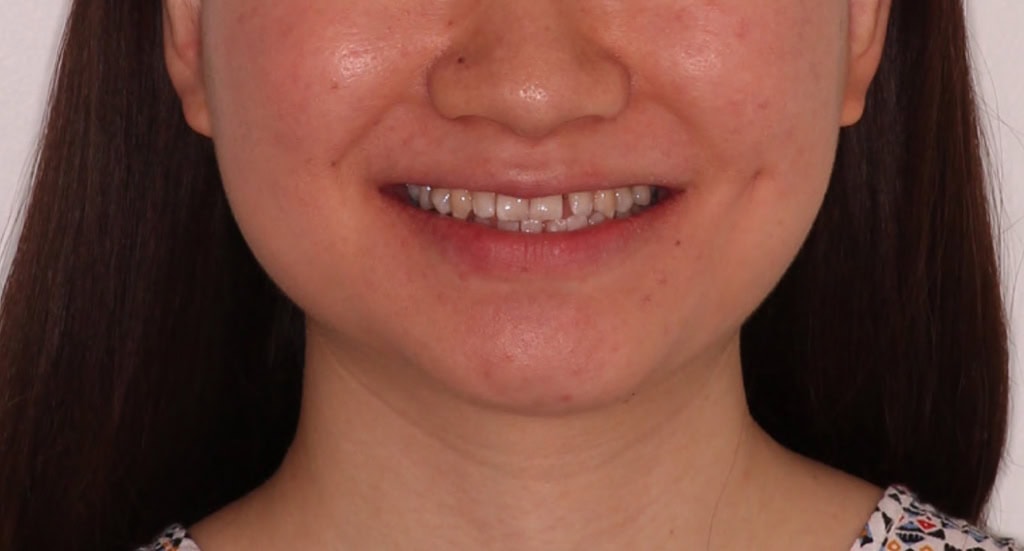 Patient 9 Before with Protrusion