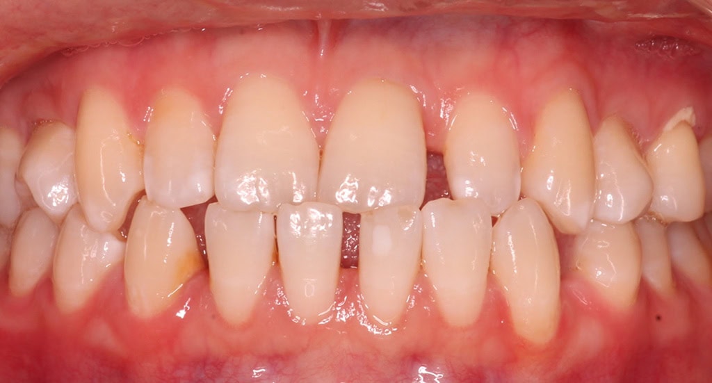 Patient 9 - Front view of teeth before Invisalign