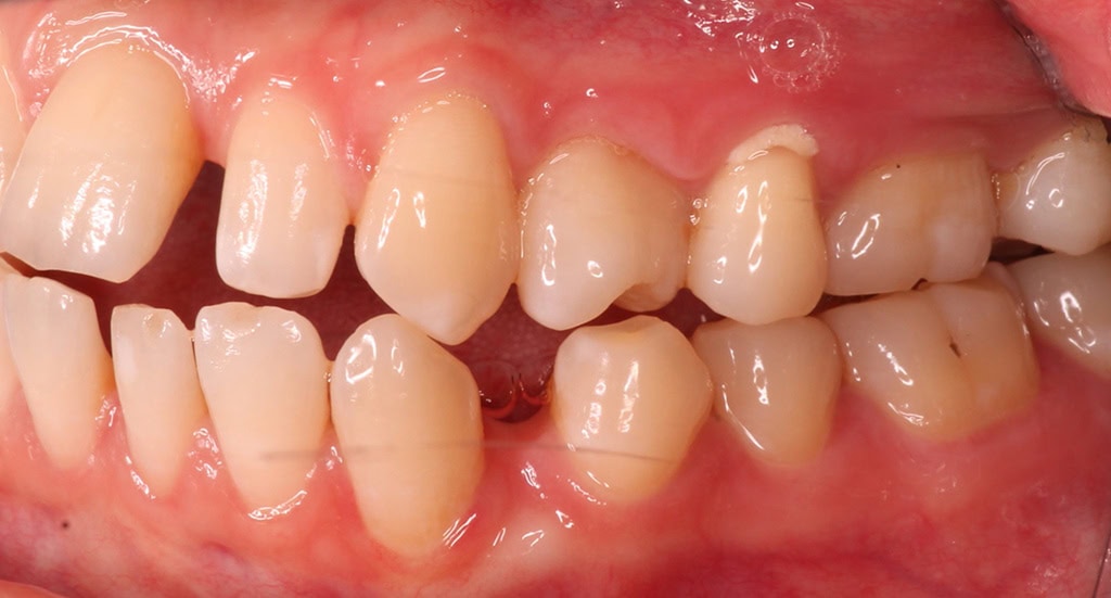 Patient 9 - Side view of teeth before Invisalign