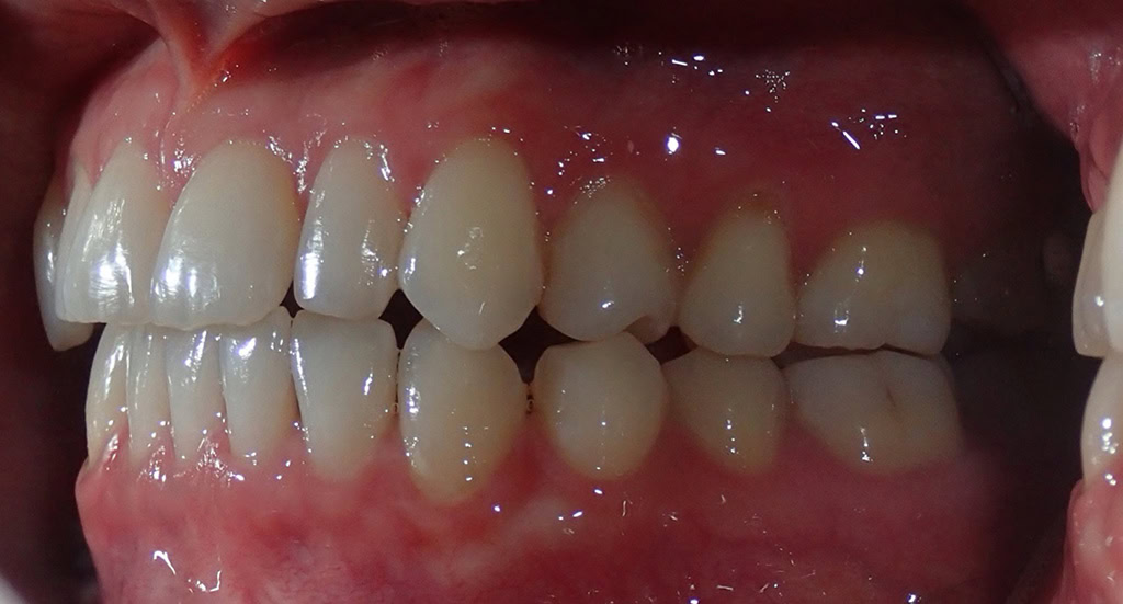 Patient 9 - Side view of teeth after Invisalign